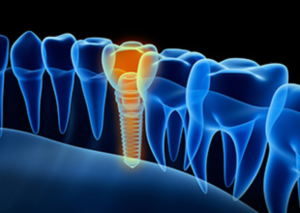 Implant dentaire - Bayonne